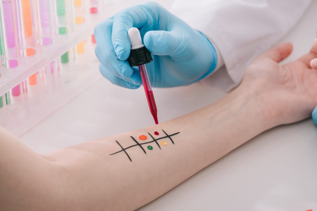 cropped view of doctor in latex glove holding pipette with liquid while making allergy testing